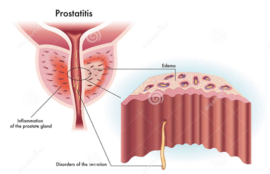 Kronik Prostat