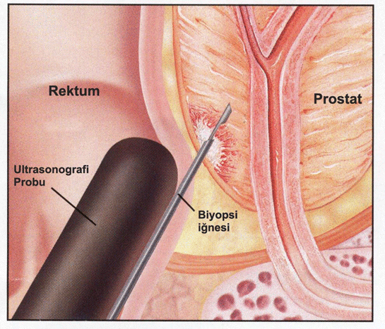 Prostat Biyopsisi